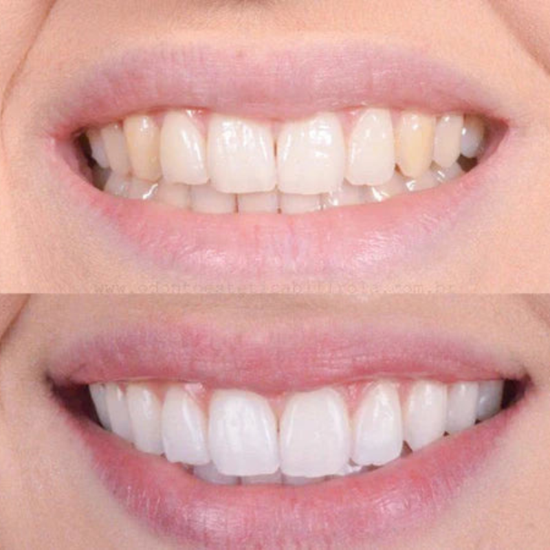 PearlWhite – Blanqueamiento Dental Rápido Para Una Sonrisa Radiante 